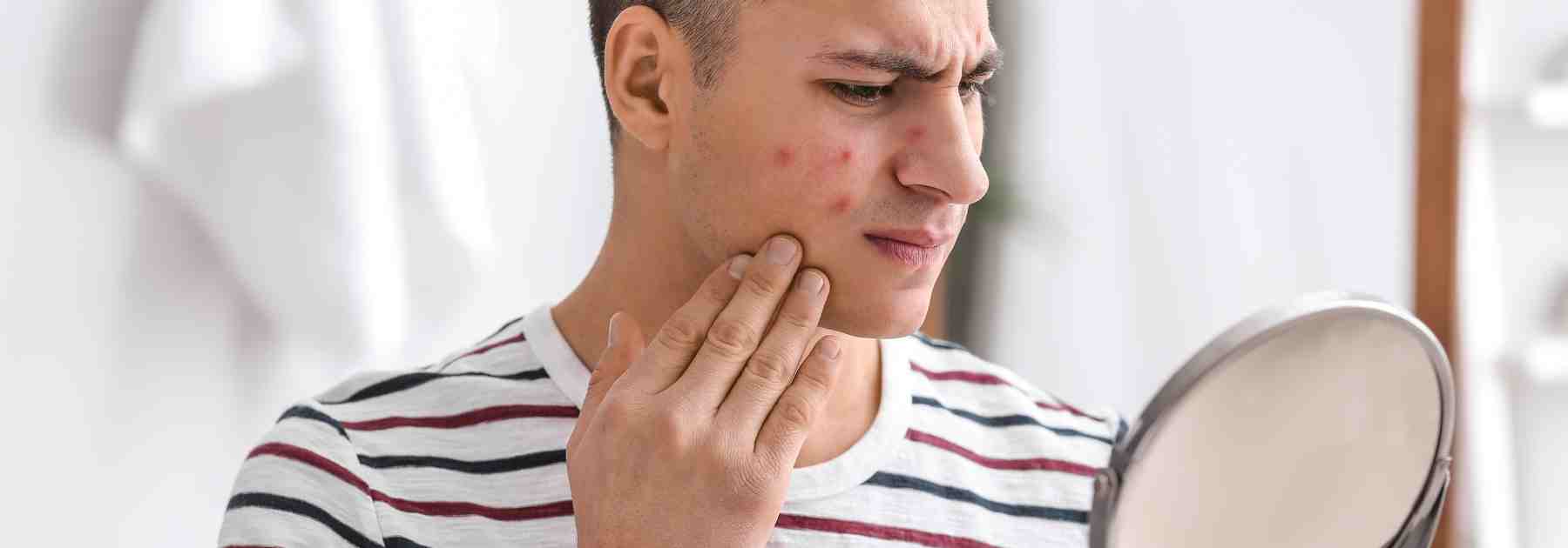 Find the right acne treatment for your skin